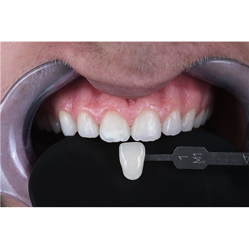 03_AWB_UR_Icon Vestibular Flairesse Bleaching Gel_Clèment_8_couleur finale obtenue_2026-01_Fig08